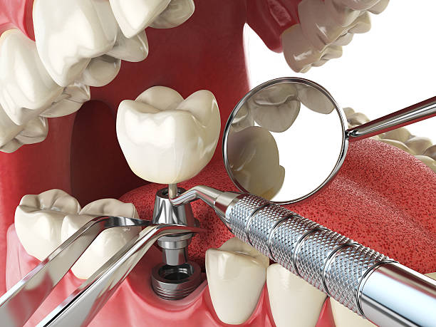 Best Emergency Root Canal Treatment in New Orleans, LA